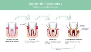 Die Infografik zeigt die verschiedenen Stadien einer Parodontitis.