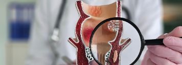 Ein Arzt hält eine Lupe und ein anatomisches Modell des Rektums mit Hämorrhoiden in den Händen.